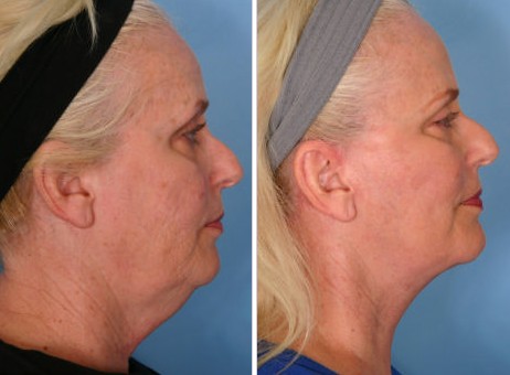 Facelift Before And After. face lift before and after