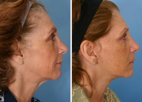 Dr. Kent Hasen: Facelifts Before and After Photos