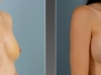 Dr. Kouros Azar, Breast Reconstruction Photos