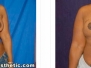 Dr. Eric Chang: Breast Reconstruction Photos