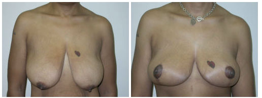 National Harbor Breast Reduction, Dr. Michael Chiaramonte 1
