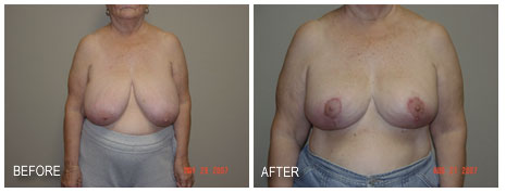 Fort Myers Breast Reduction, Dr. Audrey Farahmand 1