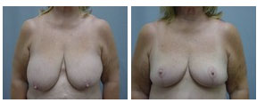 Ormond Beach Breast Reduction, Dr. Carl Lentz 1