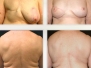 Dr. Paul Rhee: Mastectomy Photos