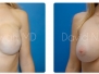 Dr. David Sayah: Mastectomy Photos