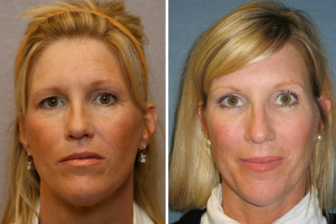 Dr. Robert Cohen, Botox and Restylane Before and After